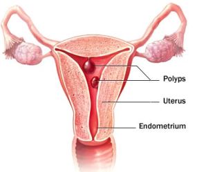 uterine-polyp
